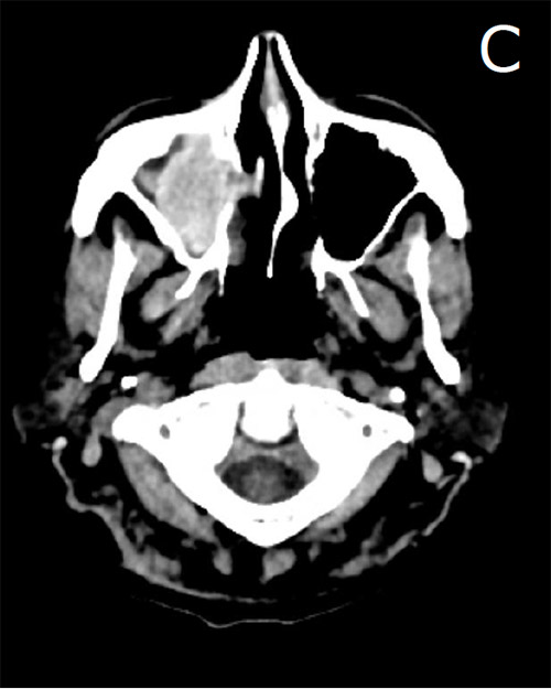 Figure C. Axial Head CT. Complete Opacification of the right maxillary sinus.