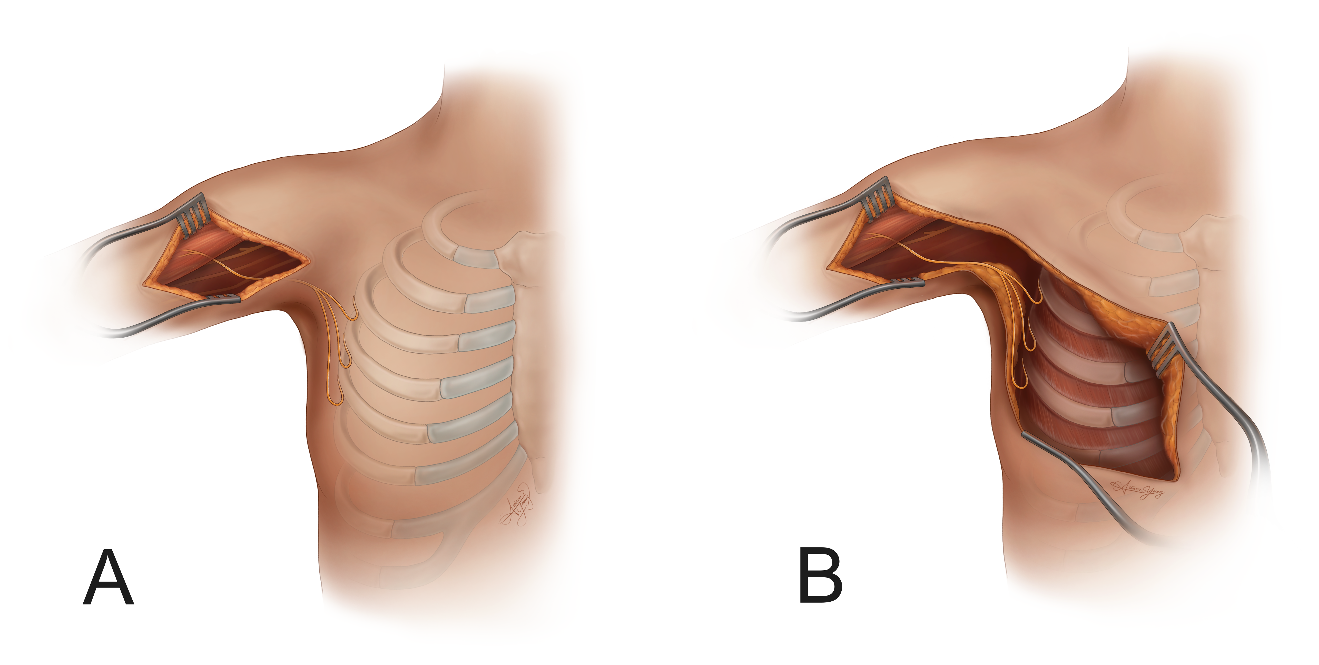 Illustration A