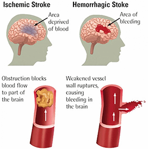 Ischemic Stroke: Obstruction blocks blood flow to part of the brain. Hemorrhagic Stroke: Weakened vessel wall ruptures, causing bleeding in the brain.