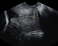 Ultrasound image of a cervical length assessment