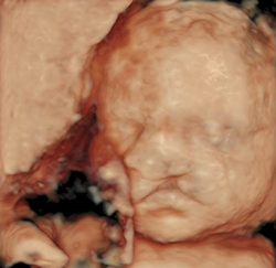 Image of an unborn baby with cleft lip/palate