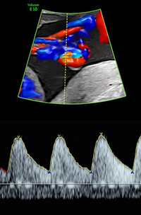 Doppler ultrasound example