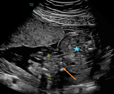 Ultrasound of fetus with gastroschisis