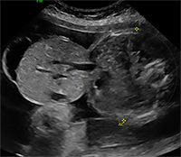 Ultrasound image of a fetus with a large omphalocele