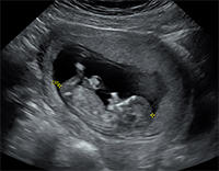 Ultrasound image of a fetus with a small omphalocele
