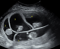 Ultrasound of multiple fetuses