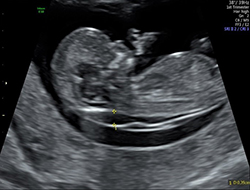 Ultrasound image showing baby