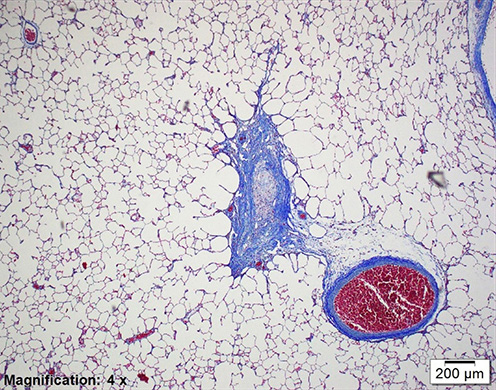 Chemical induced Bronchiolitis Oblitherans