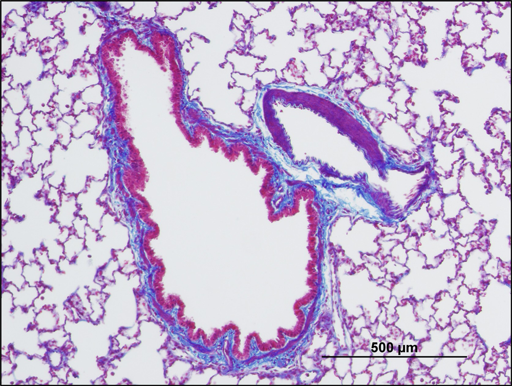 bronchiolitis obliterans
