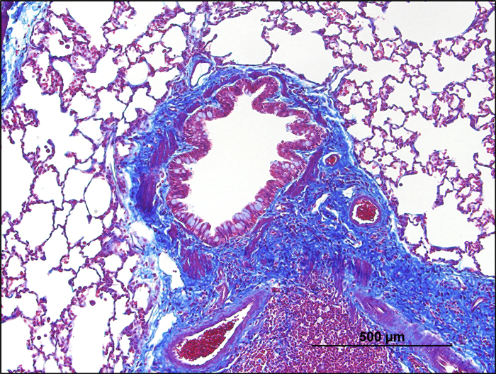 bronchiolitis obliterans