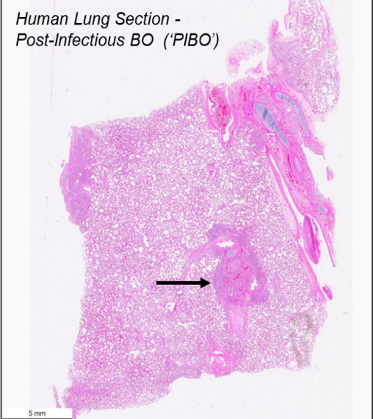 Deceased human donor lung provided from the Biorepository for INvestigation of Diseases of the Lung (BRINDL; PI: Dr. Gloria Pryhuber); arrow highlights airway with bronchiolitis obliterans (BO) pathology