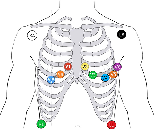 Diagram with lead placement indicated