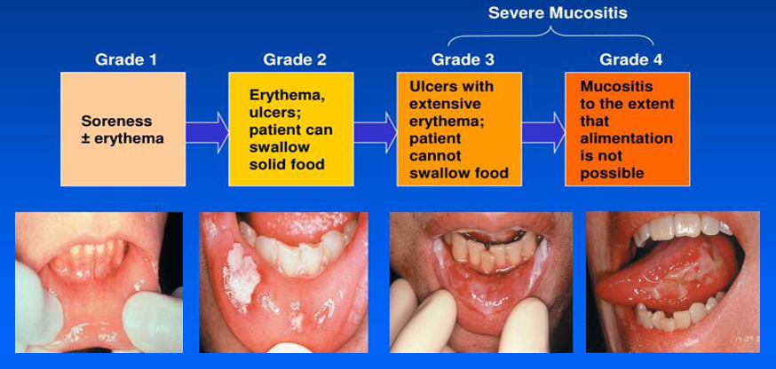 Mucositis Grades 1 through 4