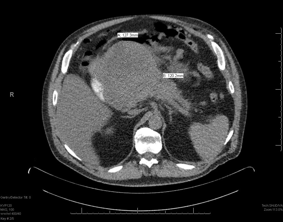 CT demonstrated an 18.6 cm complex mass in the mid-abdomen possibly arising from pancreas or bowel