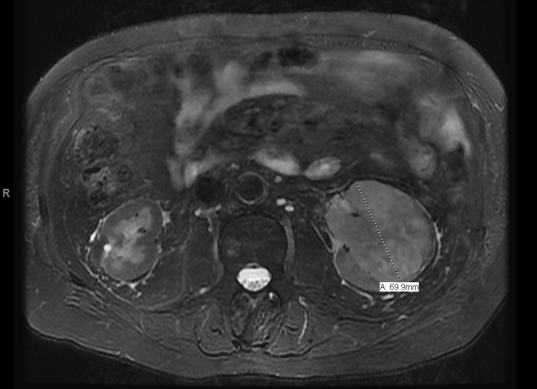 Infiltrating left-sided renal mass, with extension into the collecting system and proximal ureter.
