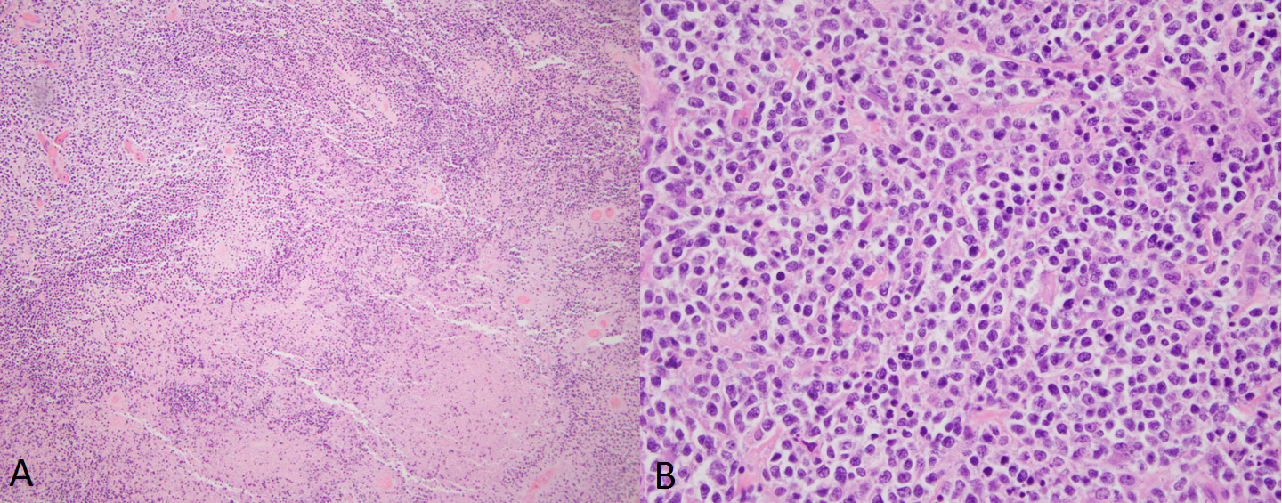 Renal parenchyma is replaced by pleomorphic smallround blue cells with high nuclear/cytoplasmic ratio
