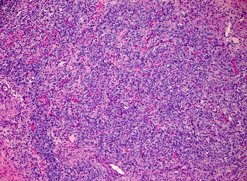 Tumor (100x magnification) showing 2 cell populations: one predominant population of basophilic cells in irregular cords with vague tubule formation, with scattered clusters of plump eosinophilic cells.