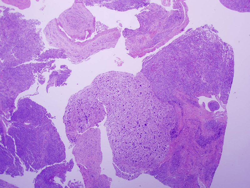 Ovarian cystectomy specimen (20x magnification) showing areas of tumor with heterologous sarcomatous elements.