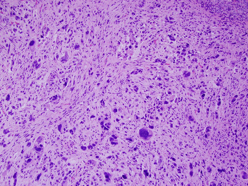 Heterologous sarcomatous area of tumor (100x magnification) showing marked pleomorphism and hyperchromasia.