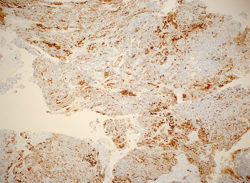Both cell population show positive cytoplasmic staining for inhibin.  The eosinophilic cells generally show stronger and more diffuse staining than the basophilic tumor cells.