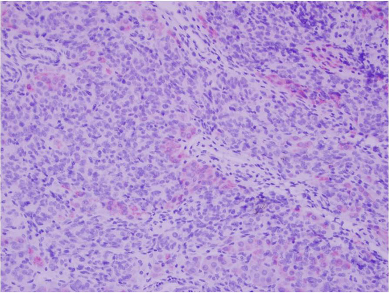 The eosinophilic cell population also shows positive staining for Melan-A