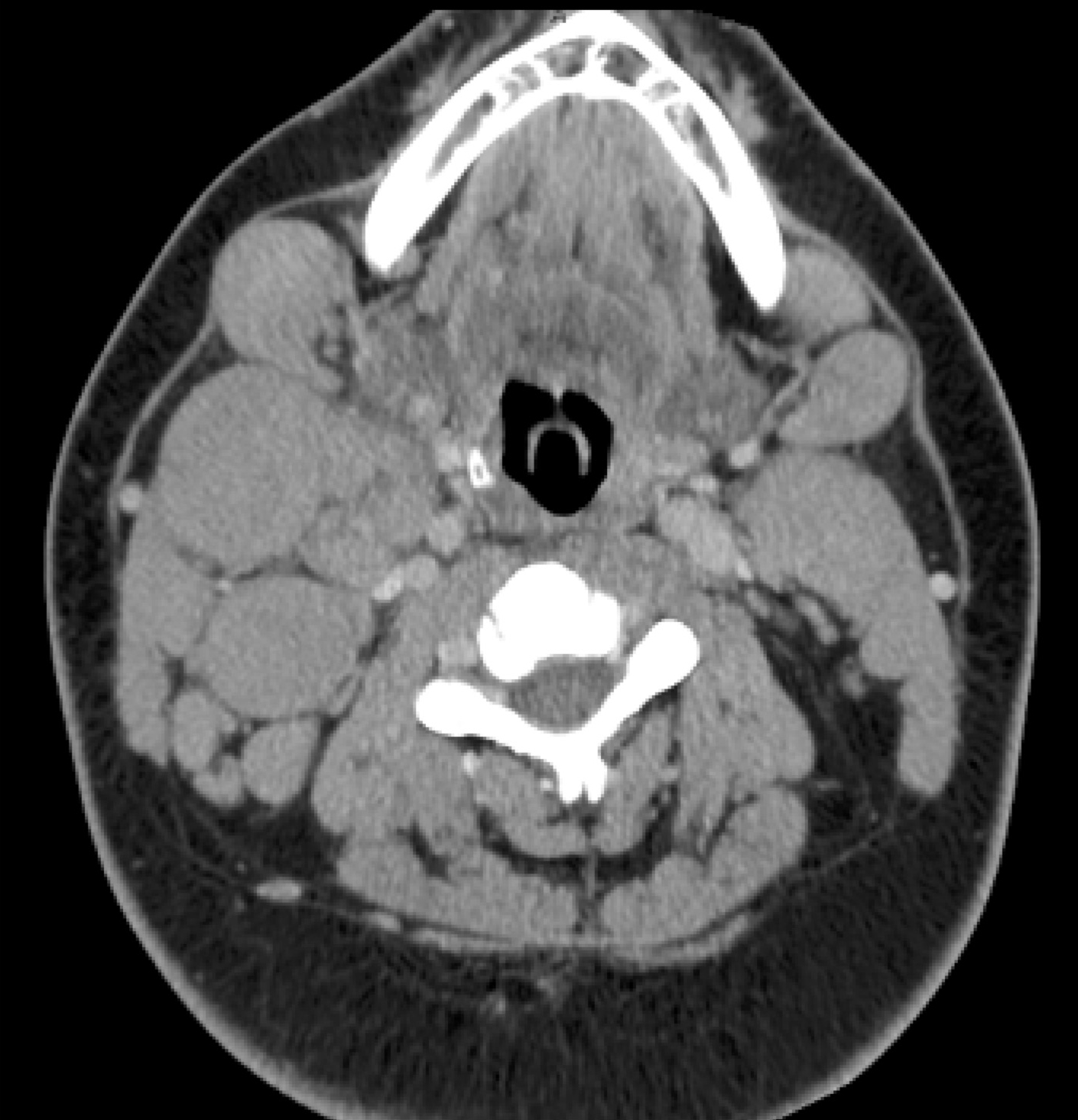 CT scan at presentation reveals bilateral cervical lymphadenopathy.