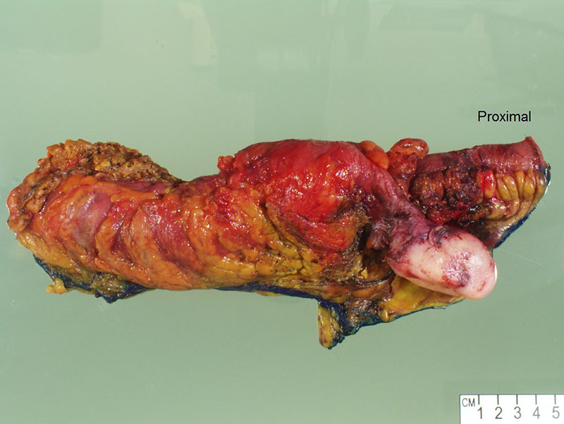 Distal appendix involved by a 6 cm tan-white and firm mass.