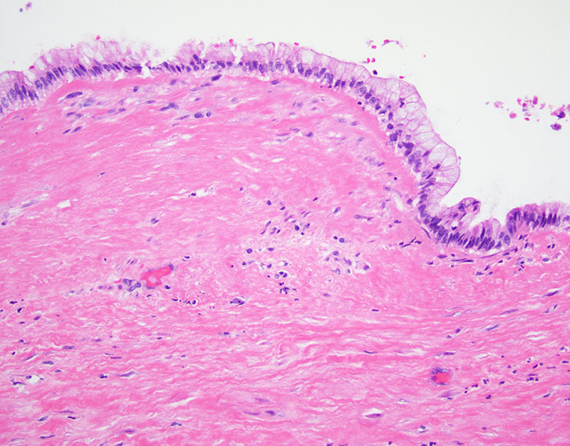 Low-grade mucinous epithelium.