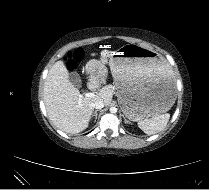 CT scan revealed two exophytic masses originating from the greater curvature of the stomach