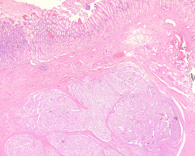 Resection of gastric masses