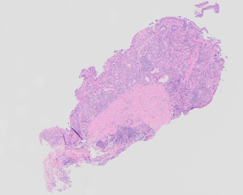 Figure 1: H&E staining at 4x magnification shows gastric mucosa with increased inflammation within the lamina propria, sloughing of the surface epithelium, and surface epithelial damage.