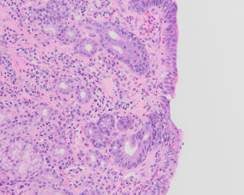 Figure 2: 20x magnification shows thickened layer of subepithelial collagen with increased plasma cells, intraepithelial lymphocytes, and eosinophils.