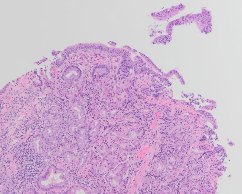 Figure 3: 10x magnification shows atrophy of the oxyntic mucosa and pyloric gland metaplasia.