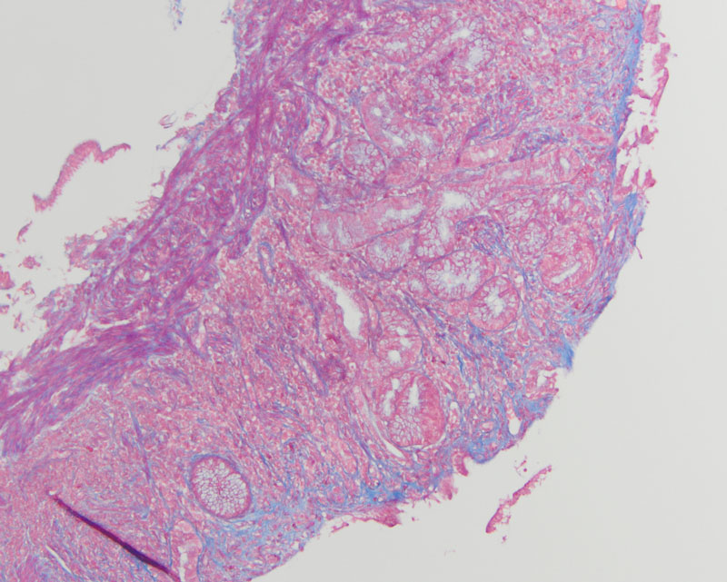Figure 4: Trichrome highlighted the thickened subepithelial collagen table (10x magnification).