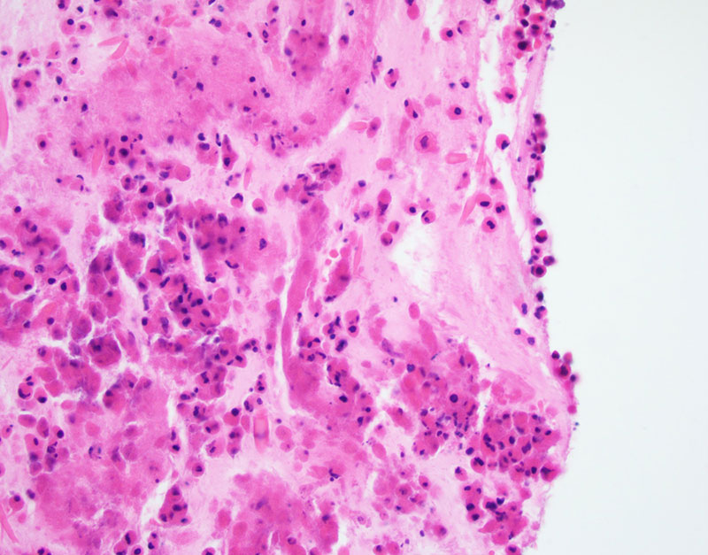 Figure 2: Eosinophilic background debris including Charcot-Leyden crystals, clinically consistent with the patient’s history of asthma
