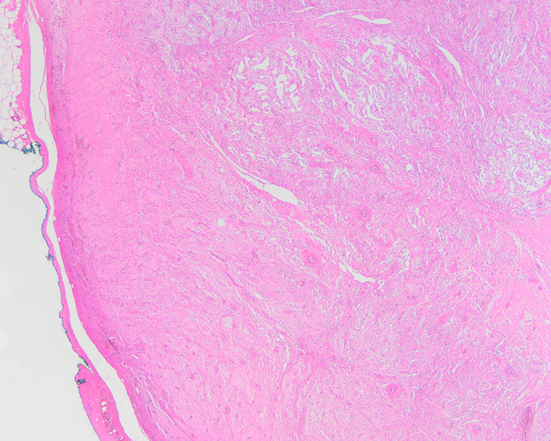 Figure 1: The lesion (2x magnification) demonstrated prominent vasculature,pseudovascularspaces, and blandspindle cells in short fascicles with focal mild atypia.