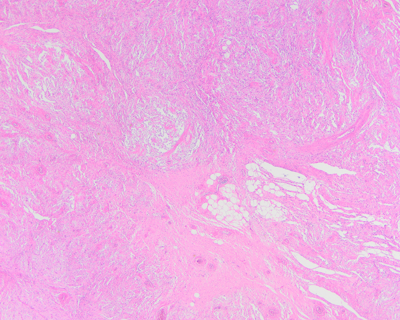 Figure 3:Intralesional fat was present (2x magnification).