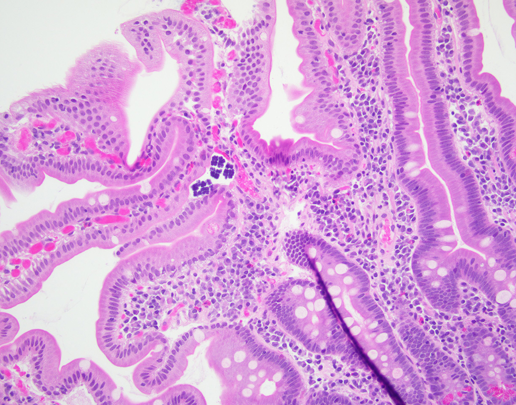 Figure 2: Rare basophilic organisms identified on the luminal surface of the duodenal biopsy specimen without an associated inflammatory response.