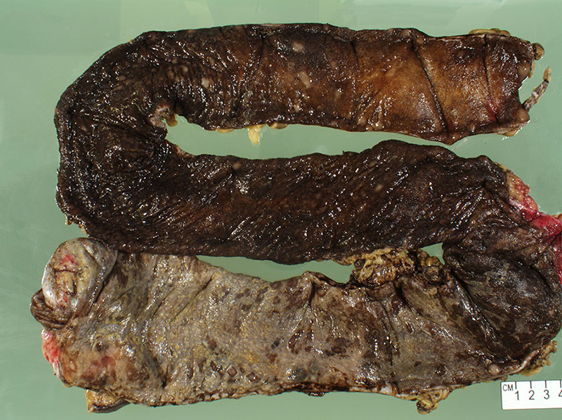 Figure 1: The colonic mucosa is dark red, hemorrhagic, and diffusely ulcerated with tan plaque-like material in the cecum and ascending colon.
