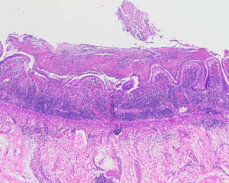 Figure 2: Histologic examination demonstratessevere active chronic ileitis with ulceration.
