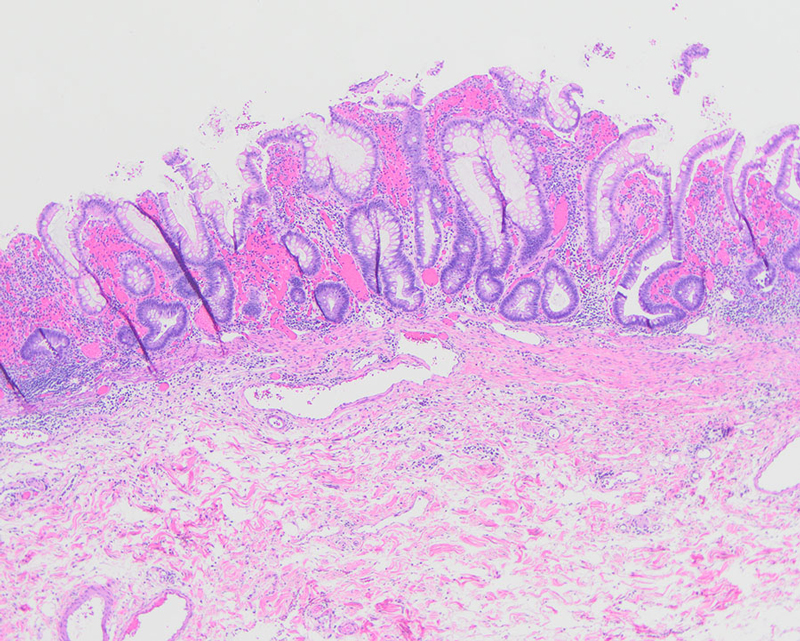 Figure 3: Diffuse, severe active chronic colitis with ulceration.
