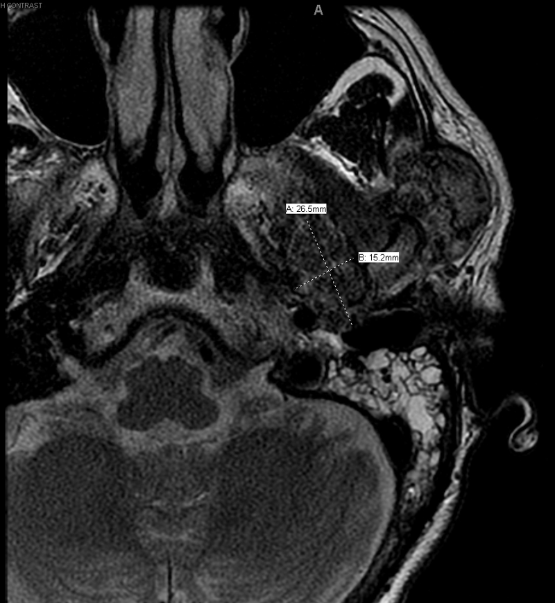 MRI reveals heterogenous, enhancing mass-like extracranial lesions at the left sided skull base surrounding the left TMJ, larger in size and number compared to previous MRI. 