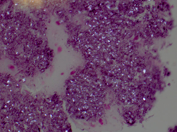 The biopsy specimen of the left skull base lesion demonstrated extensive basophilic calcifications with polarizable rhomboid shaped crystals consistent with calcium pyrophosphate dihydrate (CPPD) crystal deposits. 