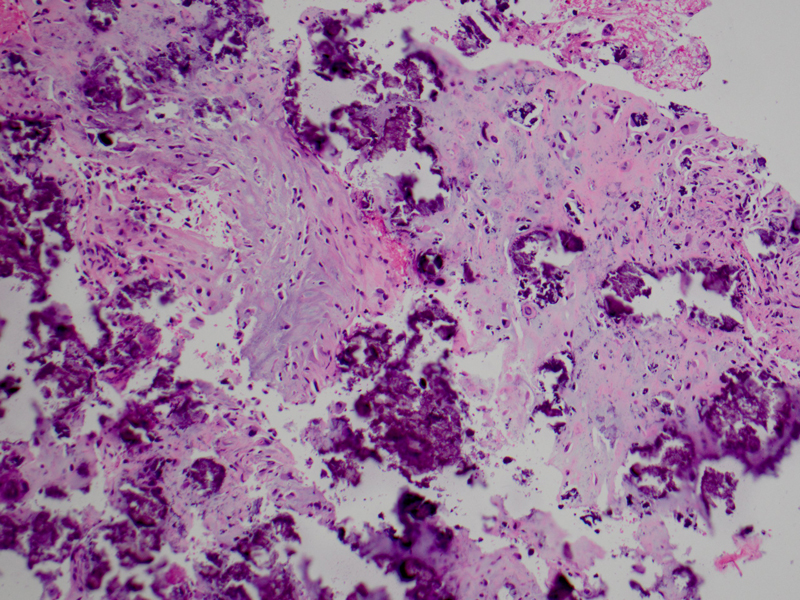 The deposits are associated with reactive histiocytes and giant cells in addition to extensive chondroid metaplasia with atypia.