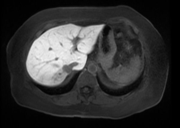 Figure 1: MRI shows a 2.0 x 1.6 cm mass in the posterior right hepatic lobe, immediately posterior to and contacting the IVC.