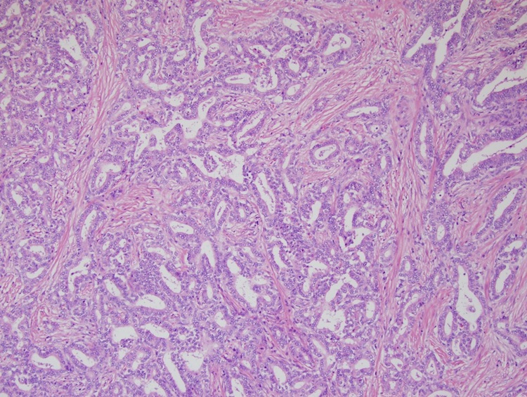 Figure 3: Histologically, the tumor was composed of tubules within a densely sclerotic and desmoplastic stroma.
