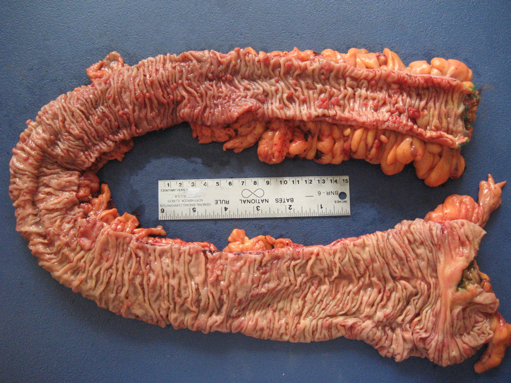 Figure 1. Total colectomy specimen with numerous small mucosal polyps. Image courtesy of K. Weyhing, PA (ASCP)CM.