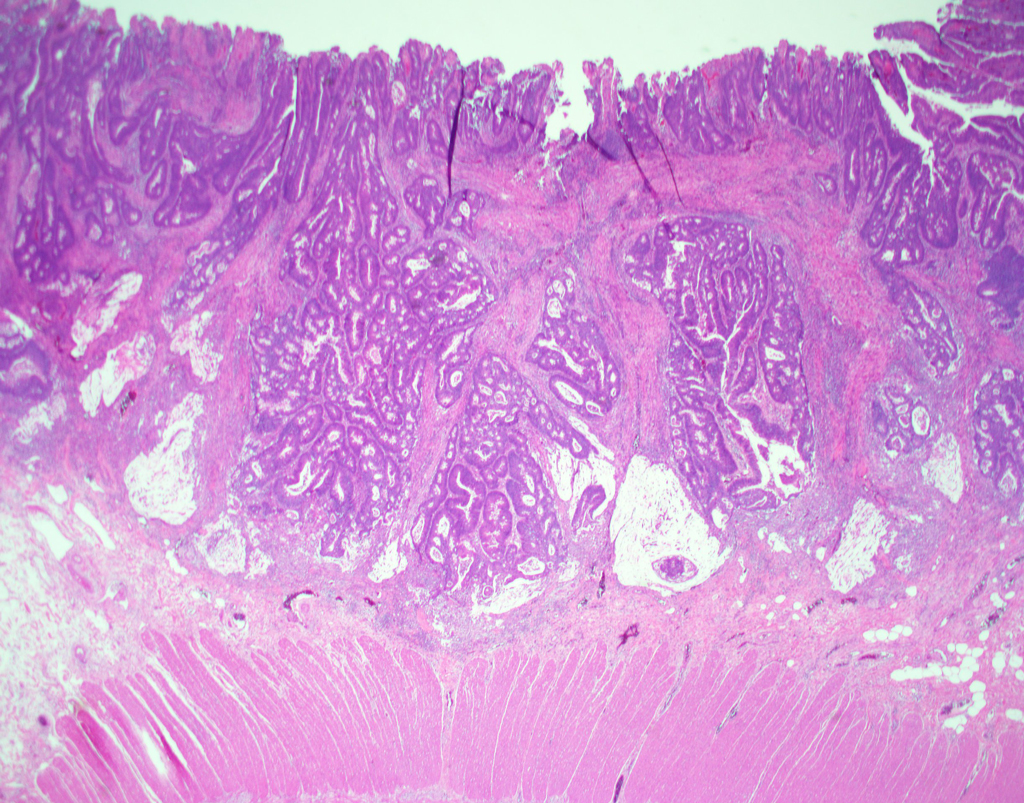Figure 4. Larger polyp demonstrates invasive adenocarcinoma, extending into the submucosa.