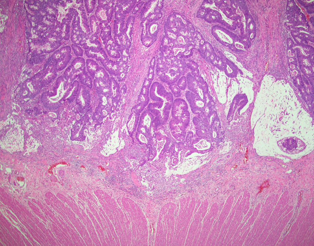 Figure 5. Larger polyp demonstrates invasive adenocarcinoma, extending into the submucosa.