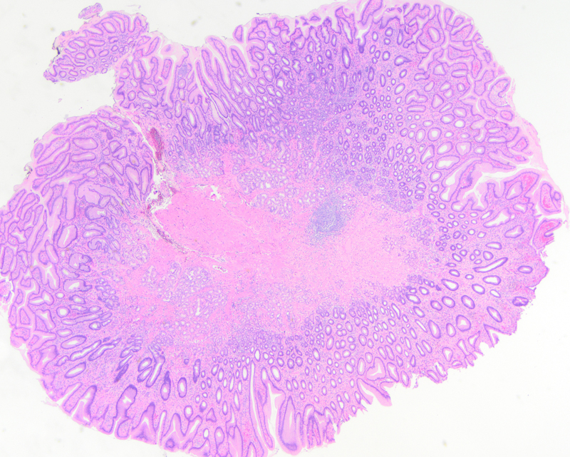 Figure 2: Hyperplastic polyp of the stomach (2x).